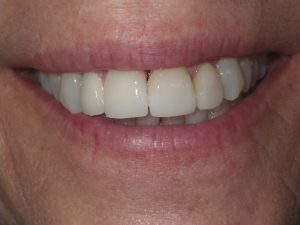 Actual implant dentistry patient of San Luis Obispo dentist Dr. Deborah McNeil-Amorteguy, DDS.