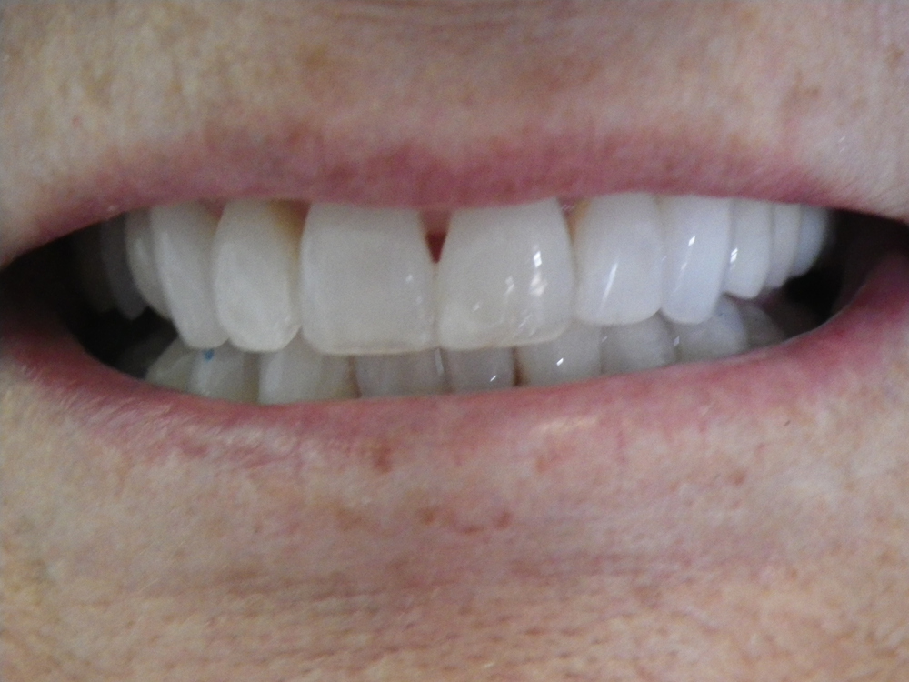 San Luis Obispo dentist, Dr. Deborah McNeil-Amorteguy DDS, orthodontics patient before and after photo