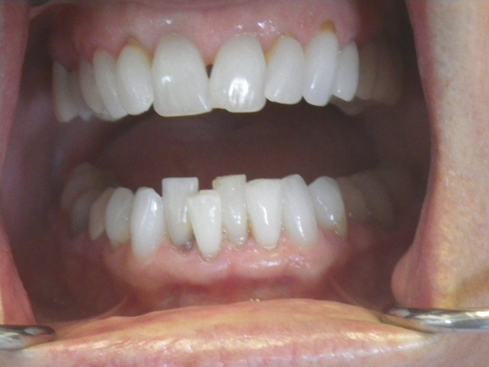 San Luis Obispo dentist, Dr. Deborah McNeil-Amorteguy DDS, orthodontics patient before and after photo